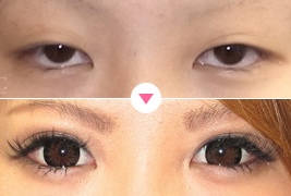目が小さい人の二重手術の症例