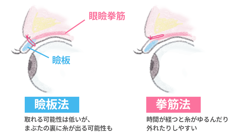 瞼板法と拳筋法